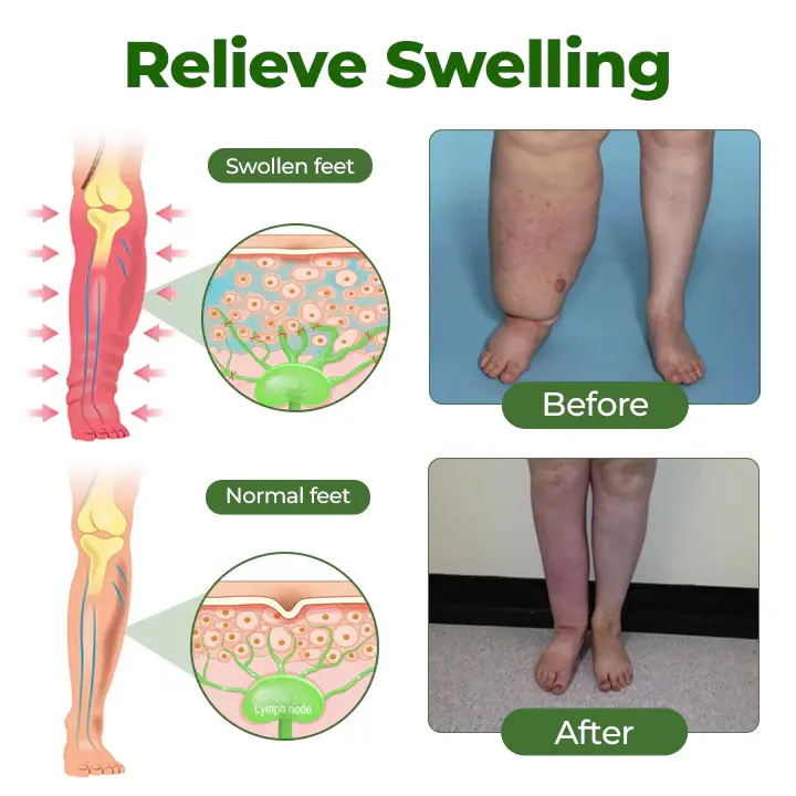 FluidEase Leg Therapy Edema Cream - Image 7