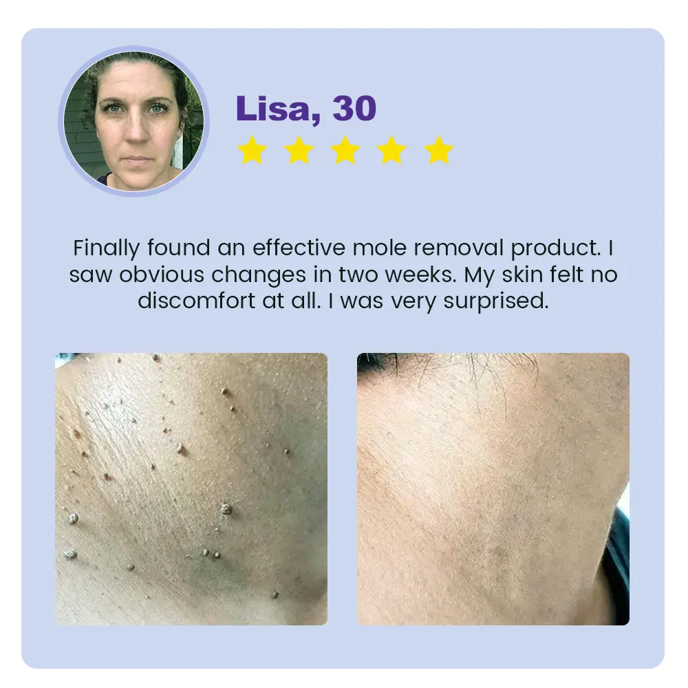 ✅ Official Store: Clarivine Dissolver Mole & Dark Spot Removal Bio-Gel - Image 8