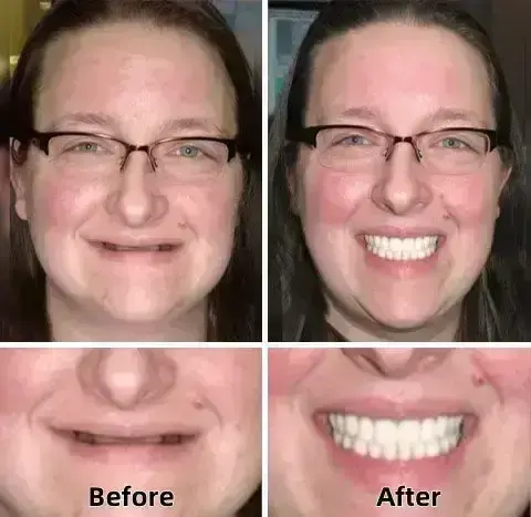 –Advanced Custom-Fit Functional Dentures - Image 4