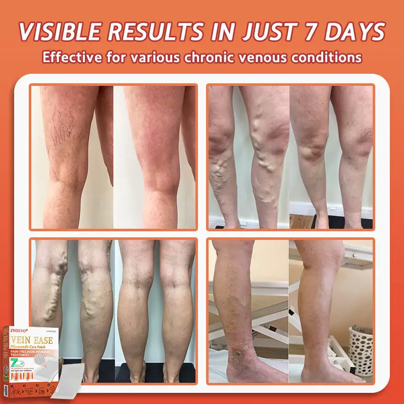 Vein Ease Microneedle Care Patch(For Spider Veins, Varicose Veins, Swelling & Leg Fatigue) - Image 4