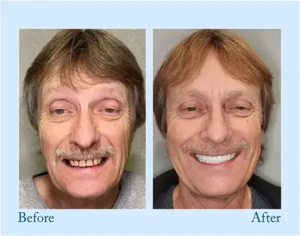 – Premium-Zahnprothese - Image 8