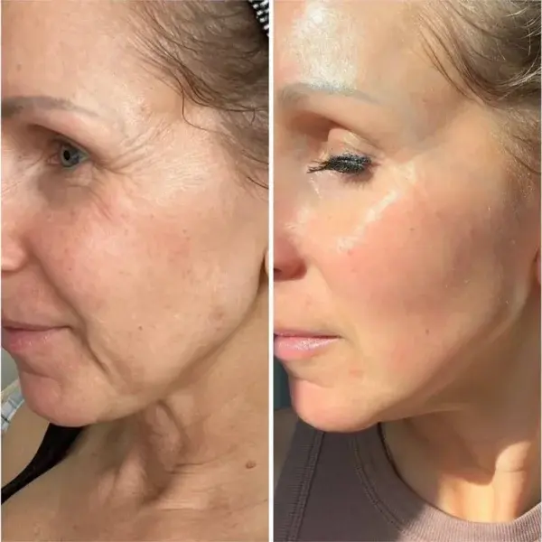 The Vita A Retinal Shot Tightening Booster - Image 9