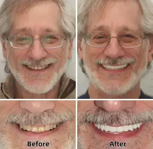 –Advanced Custom-Fit Functional Dentures - Image 5