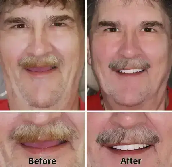 –Advanced Custom-Fit Functional Dentures - Image 6