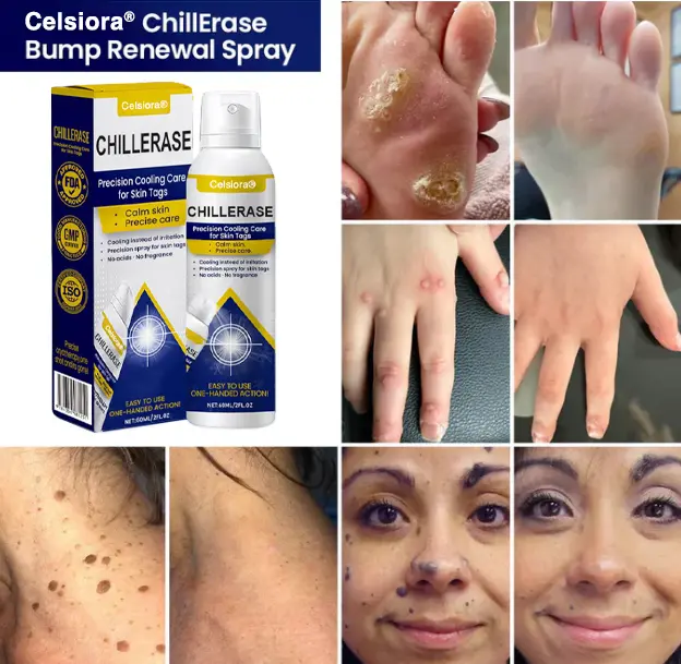 ChillErase Cooling Spray for Skin Tags - Image 2
