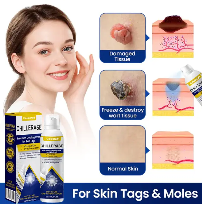 ChillErase Cooling Spray for Skin Tags - Image 4