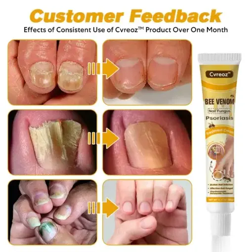 Bee Venom Nail Fungus Psoriasis Treatment Cream - Image 6