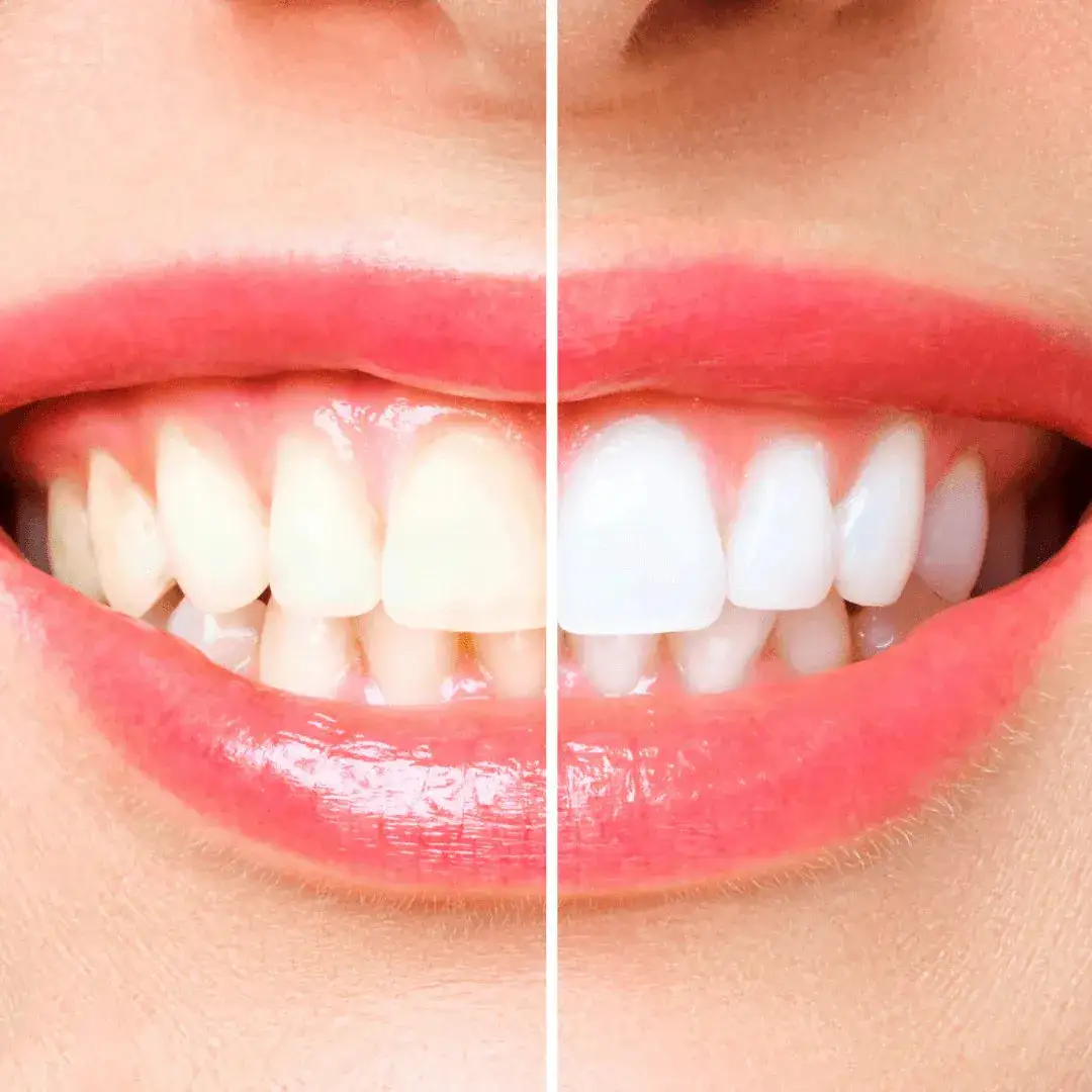360° U-Shaped Ultrasonic Adult Electric Toothbrush - Image 6