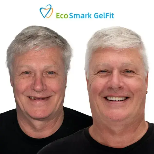 EcoSmark GelFit Dentures - Image 4