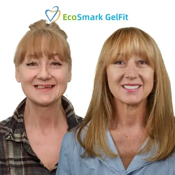 EcoSmark GelFit Dentures - Image 6