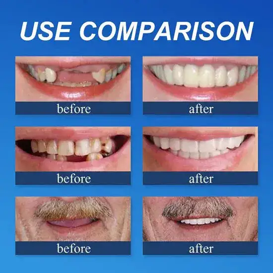 ⏰Ends Today: 70% OFF! Custom-Fit Dentures— Designed for Comfort and a Natural-Looking Smile - Image 5