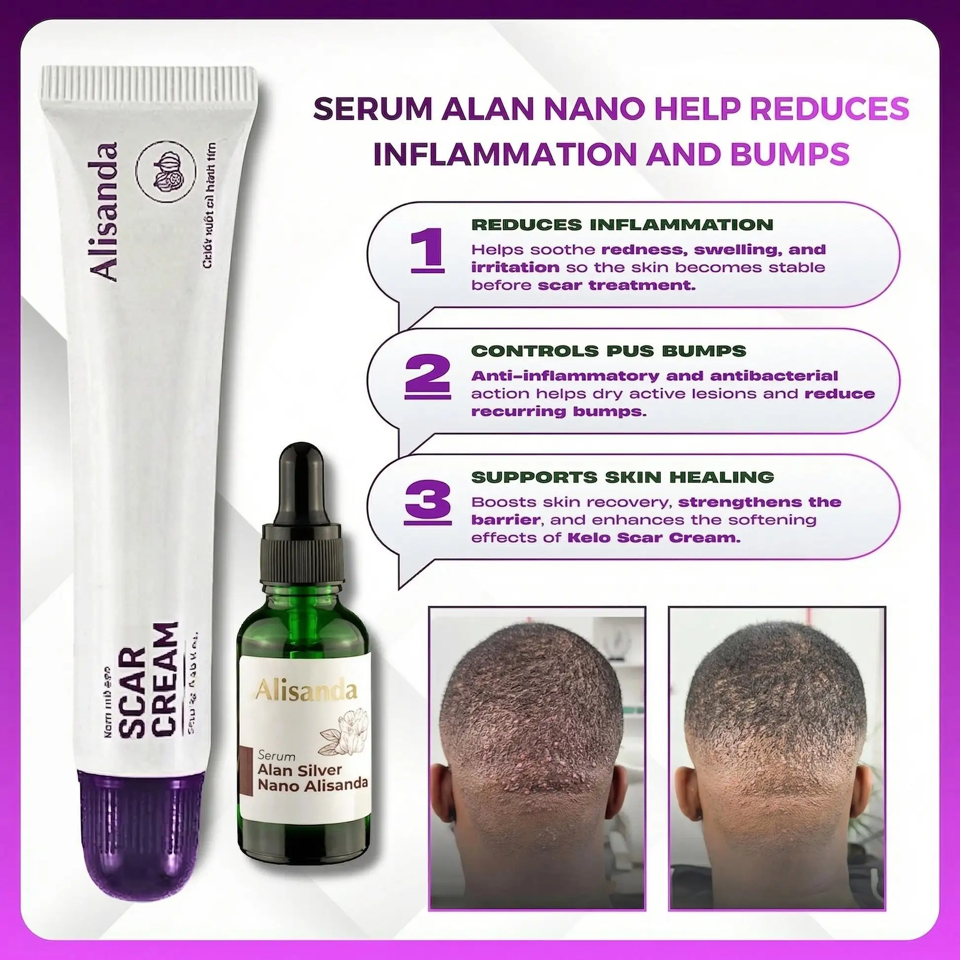 Keloid & Raised Scar Removal Cream | Alisanda 2026 - Image 3