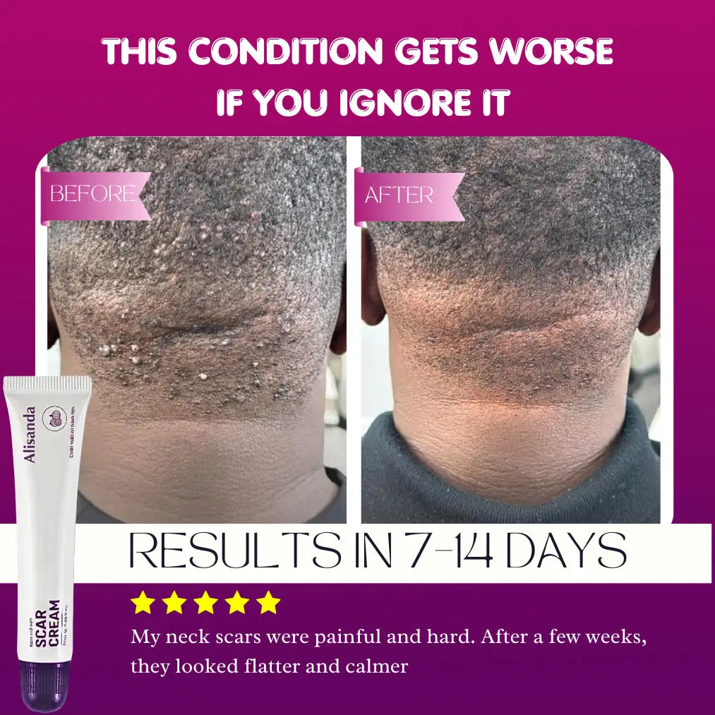 Keloid & Raised Scar Removal Cream | Alisanda 2026 - Image 5