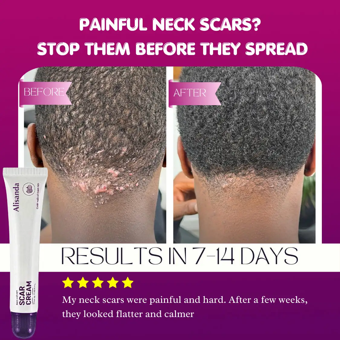 Keloid & Raised Scar Removal Cream | Alisanda 2026 - Image 6