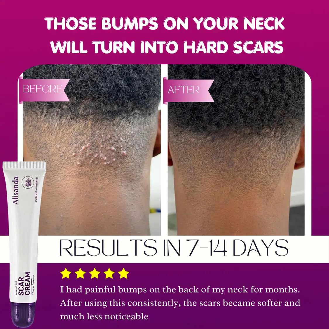 Keloid & Raised Scar Removal Cream | Alisanda 2026 - Image 7