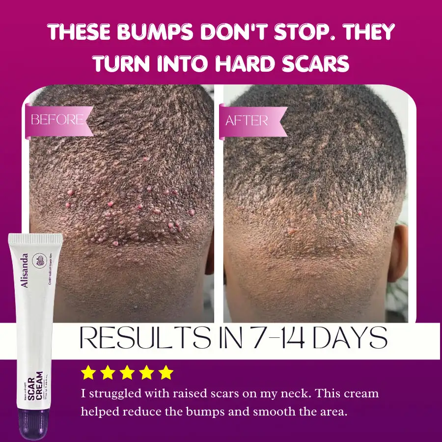 Keloid & Raised Scar Removal Cream | Alisanda 2026 - Image 8