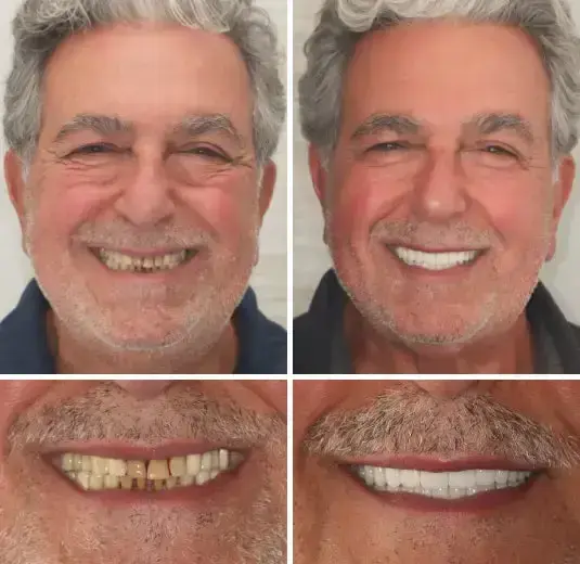 【Official Brand Store】Custom-Fit Functional Dentures — ComfortMax Edition - Image 10