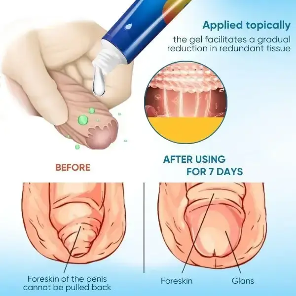 Redundant Prepuce Corrector Gel - Image 5