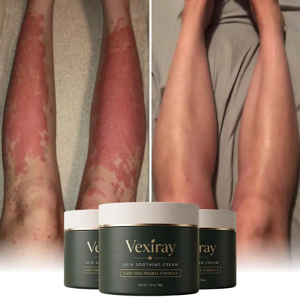 Eczema & Psoriasis Cream - Image 4