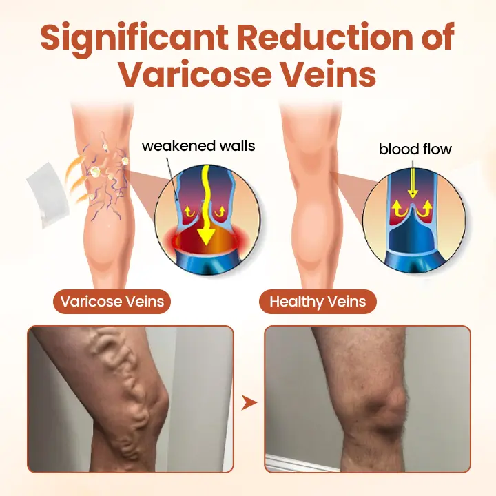 Vein Patch 2026 | Fast Varicose Vein Relief - Image 5