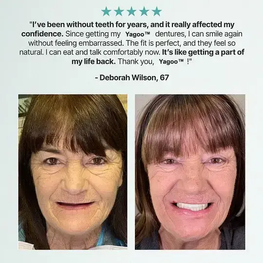 Custom Custom-Fit Full Functional Dentures - Image 5