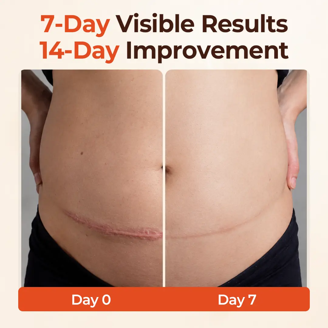 SilkStretch Natural Stretch Mark & Scar Oil - Image 2