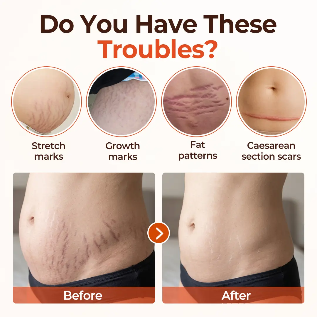 SilkStretch Natural Stretch Mark & Scar Oil - Image 4