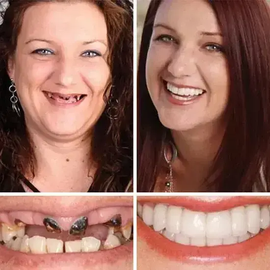 ⏰Ends Today: 70% OFF! Custom-Fit Dentures— Designed for Comfort and a Natural-Looking Smile - Image 11