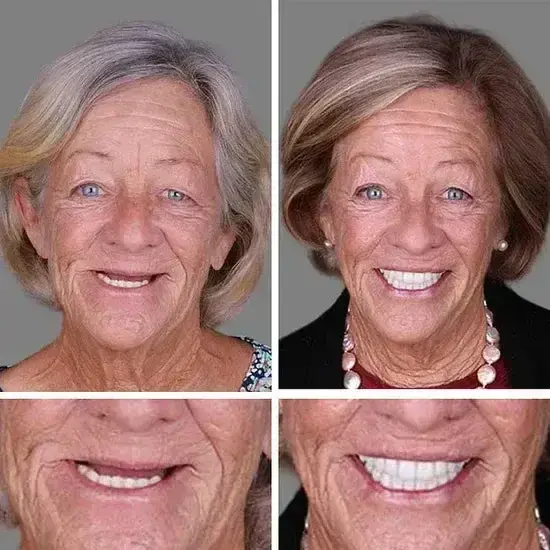 ⏰Ends Today: 70% OFF! Custom-Fit Dentures— Designed for Comfort and a Natural-Looking Smile - Image 10