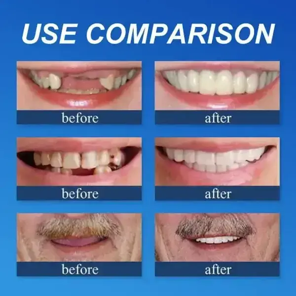 Full Denture with Strong Suctiond Custom-Fit Full Functional Dentures🦷 - Image 6