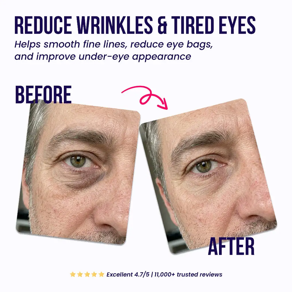 Oros Dissolving Microneedle Eye Patches for Men - Image 2
