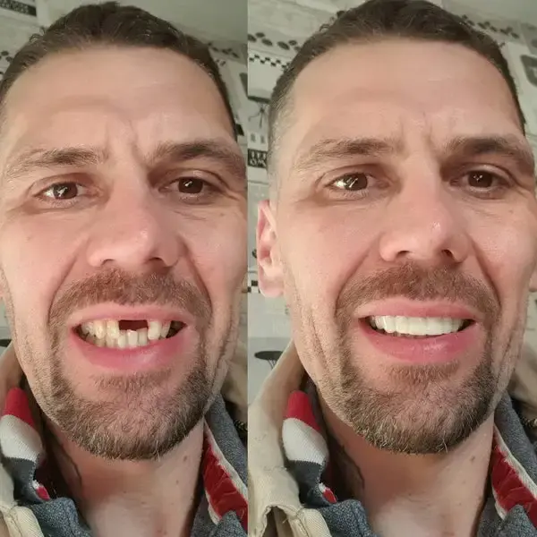 SmileFitPro BioFusion Dentures - Image 7