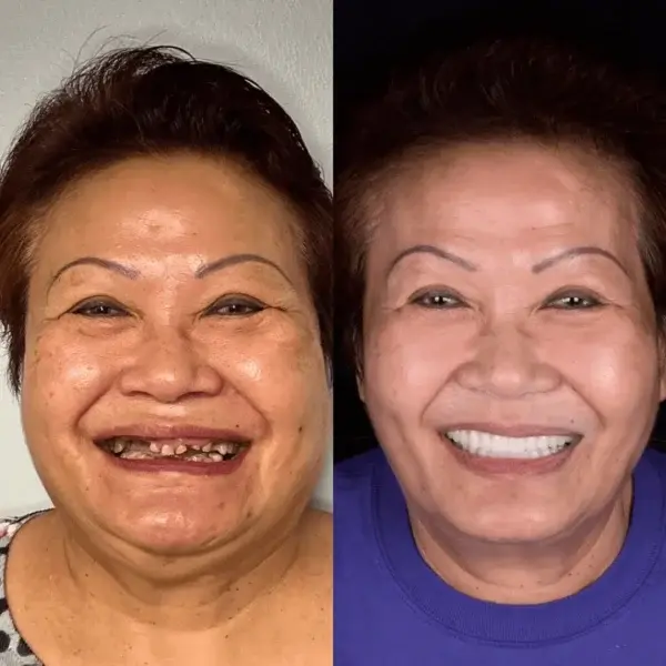 SmileFitPro BioFusion Dentures - Image 8
