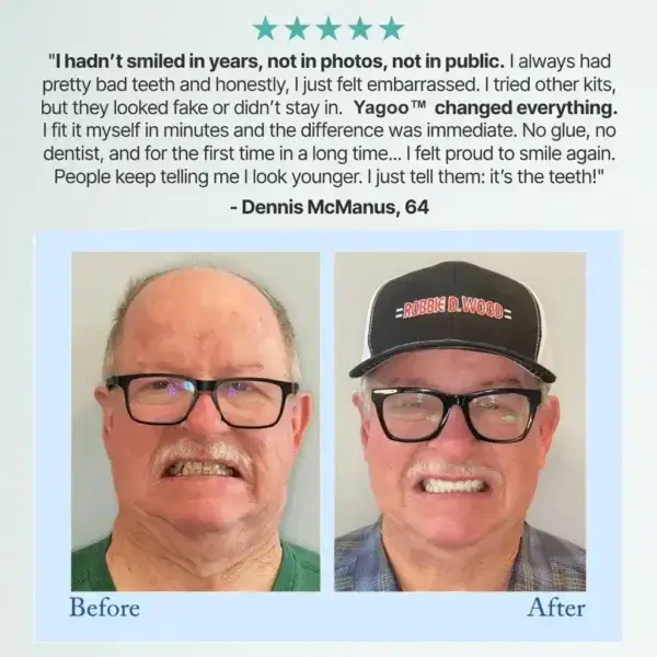 🦷Advanced Customized Full Denture Set🦷 (🔥10,000+ Sold In Last 30 Day) - Image 8