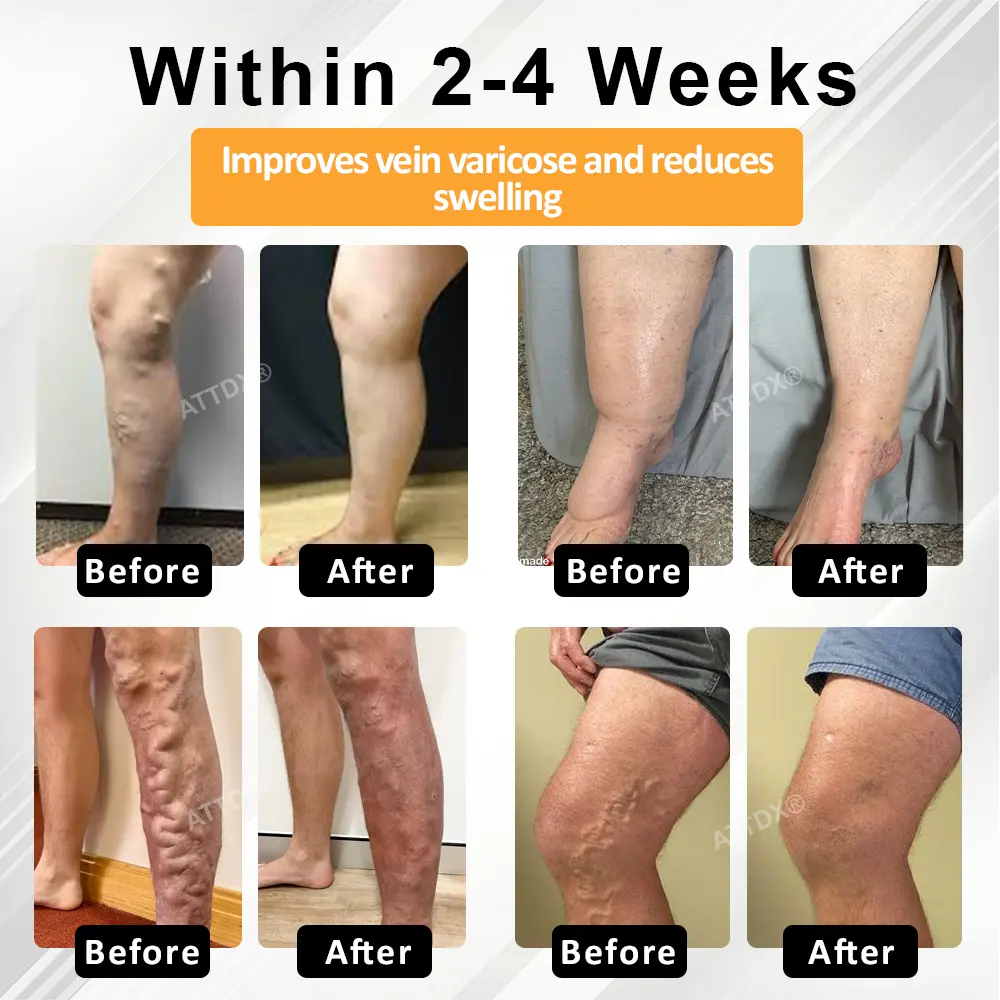 MicroSting Bee Vein Ease Patches - Image 4