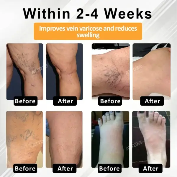 MicroSting Bee Vein Ease Patches - Image 2