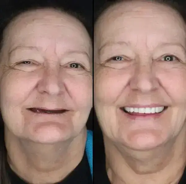 -Custom-Fit Functional Dentures - Image 2