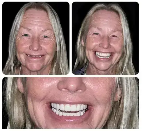 -Custom-Fit Functional Dentures - Image 3