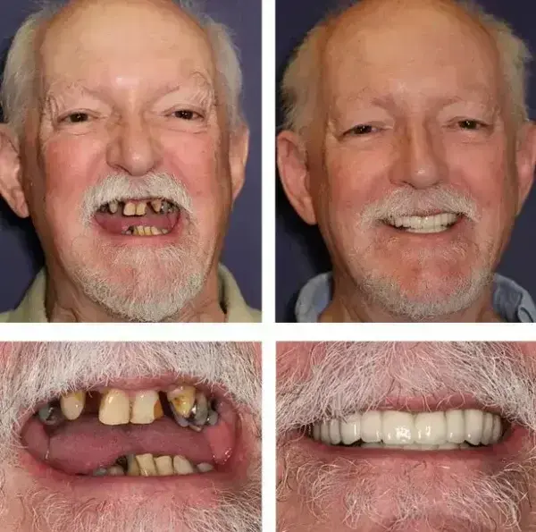 -Custom-Fit Functional Dentures - Image 5