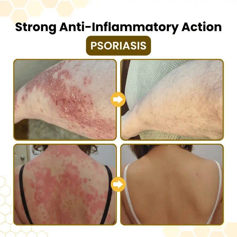 PsoriaSoothe Bee Venom Skin-Restoration Cream - Image 6