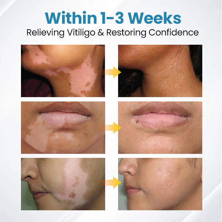 Vitiligo Therapy Device - Image 12