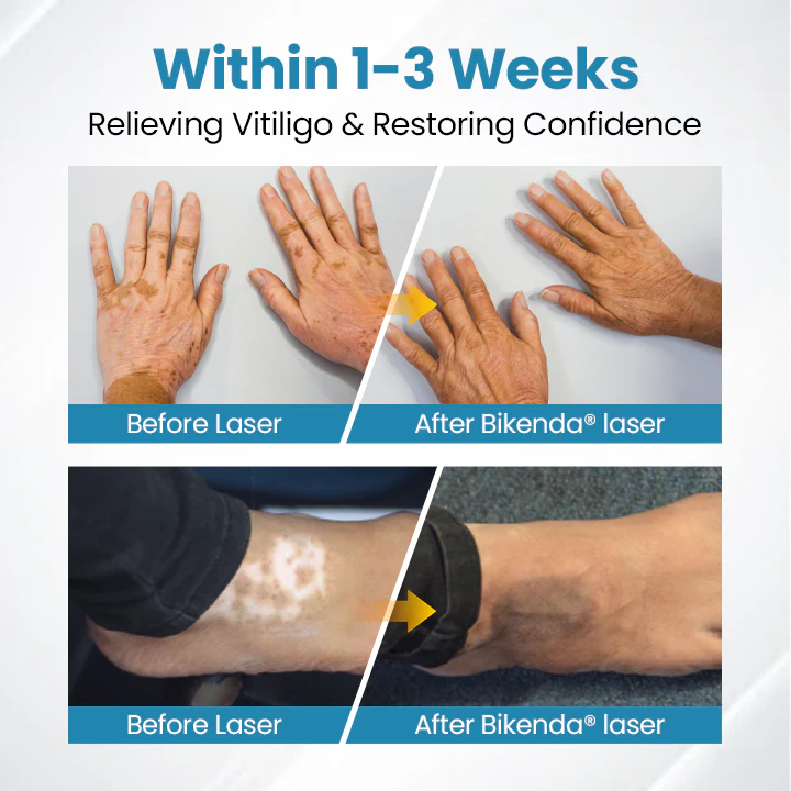 Vitiligo Therapy Device - Image 11