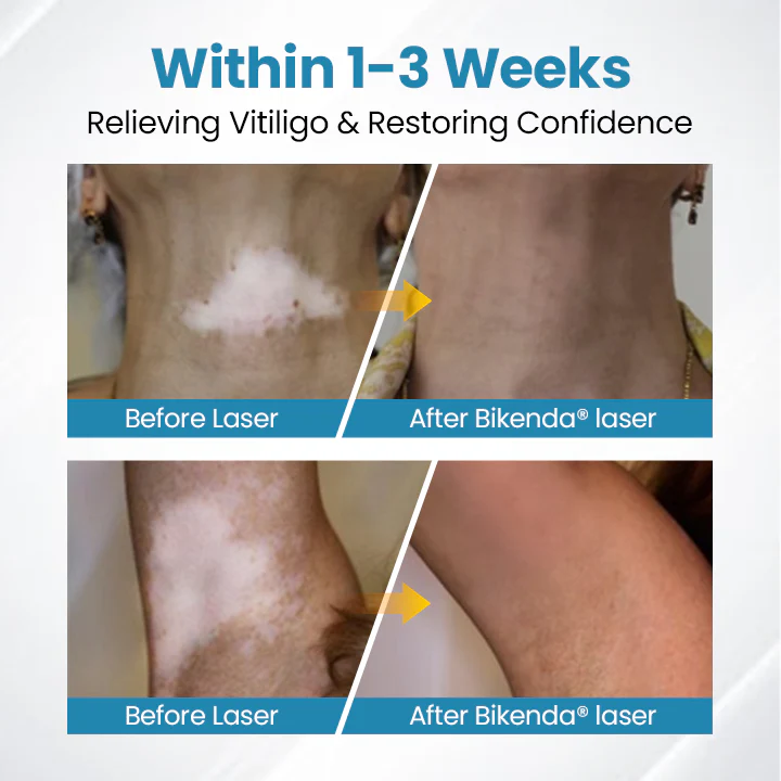 Vitiligo Therapy Device - Image 10