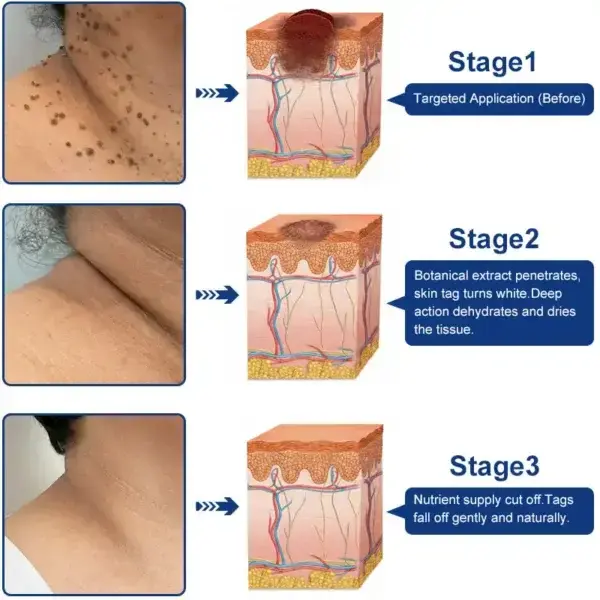 Skin Tag & Wart Removal Cream - Painless At-Home Treatment - Image 2