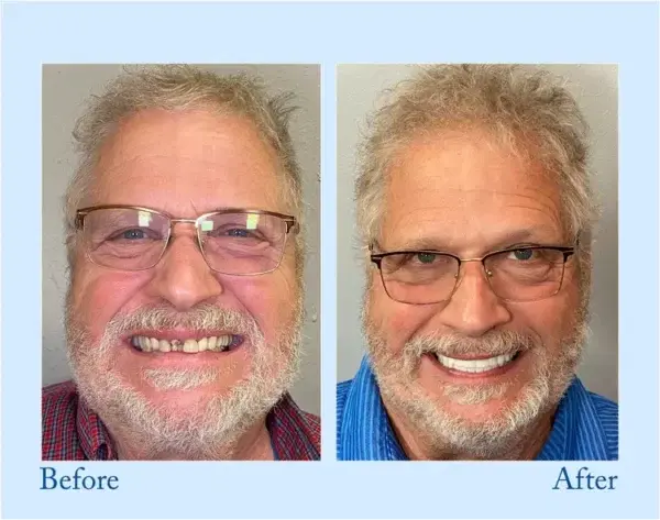 Custom-Fit Functional Dentures - Image 10