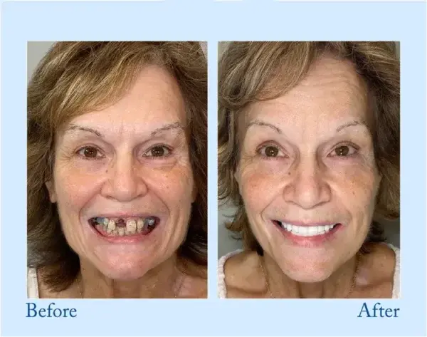 Custom-Fit Functional Dentures - Image 11
