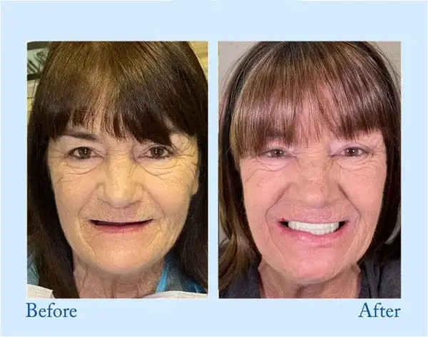Custom-Fit Functional Dentures - Image 12