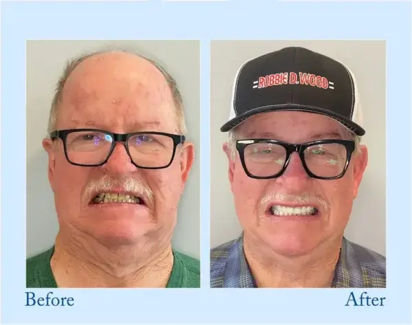 Custom-Fit Functional Dentures - Image 13