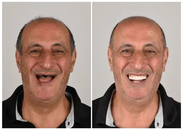 Custom-Fit Dentures | Self-Molding & Natural Smile - Image 2