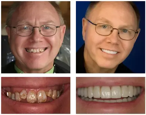 Custom-Fit Dentures | Self-Molding & Natural Smile - Image 3